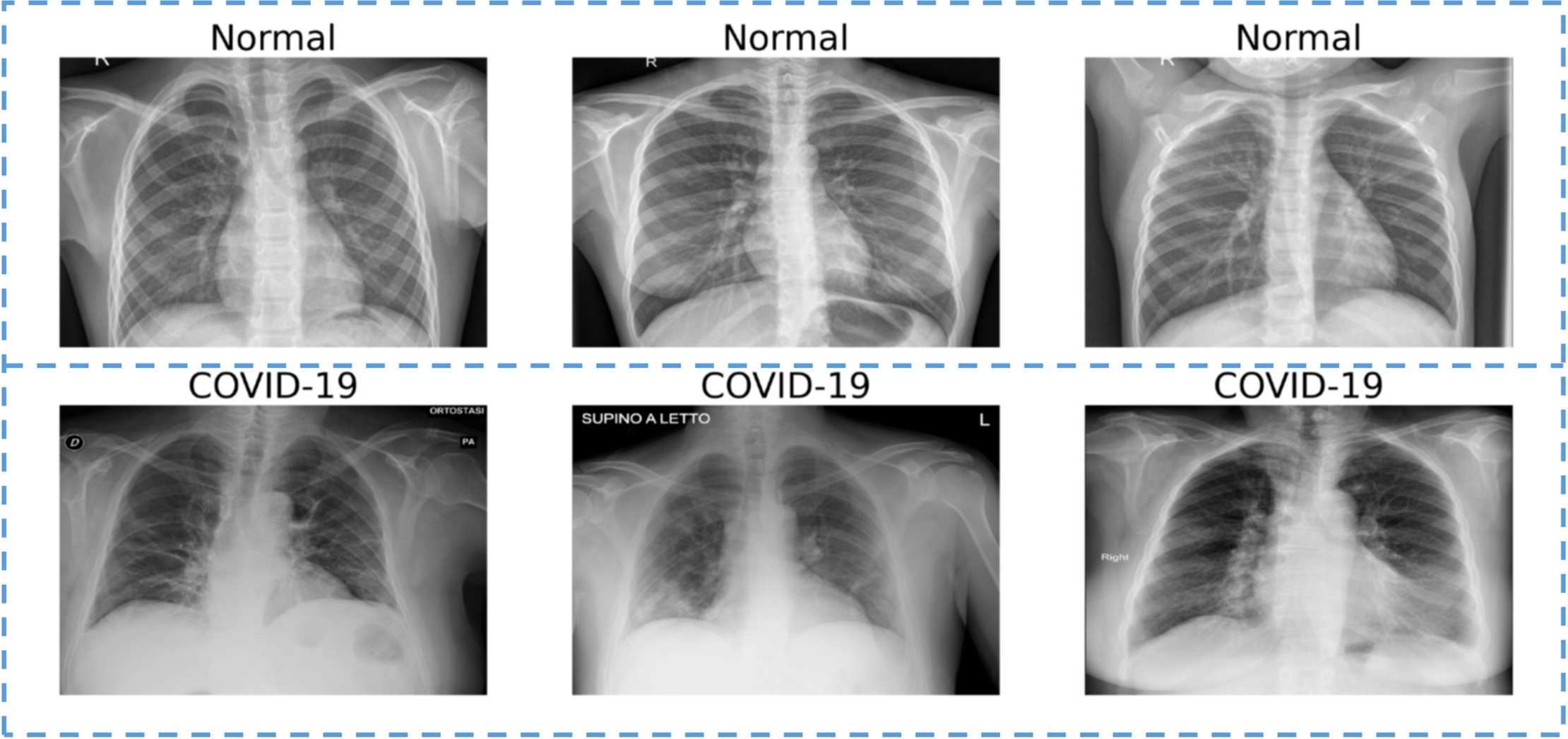 deep_and_machine_learning_for_COVID_detection